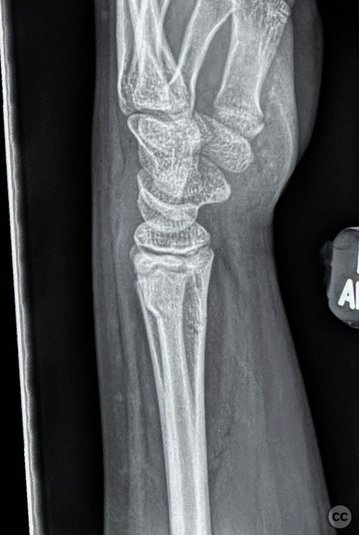 Misdiagnosed Greenstick Fracture Of The Distal Radius Lost Reduction