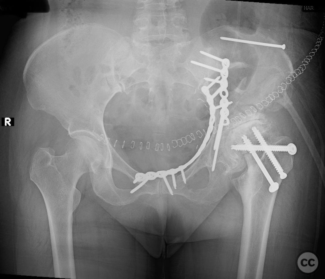 Associated Both Column Acetabular Fracture And A Femoral Neck Fracture With Oa