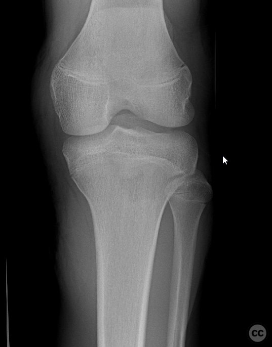 Tibial tubercle fracture - Type III