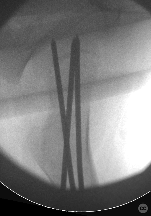 SCFE - longitudinal images over 6 years: 10-16years old