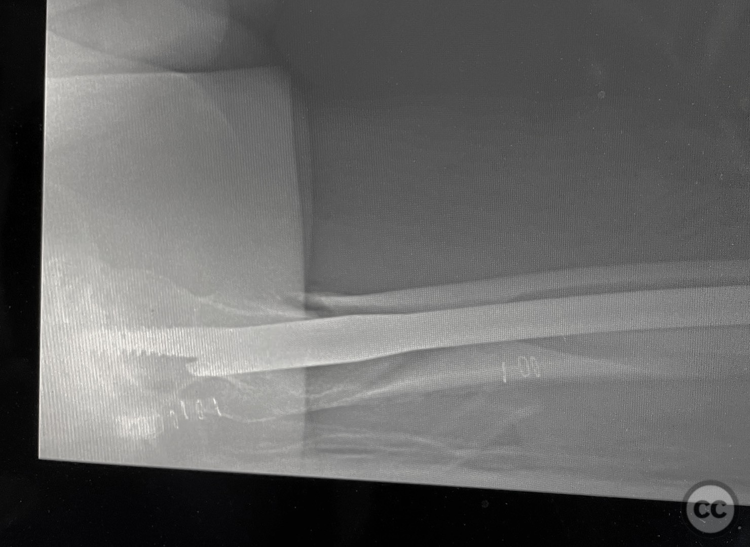 Inter- Subtrochanteric femur fracture with clamshell fragment