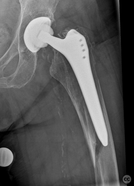 Vancouver B2 Periprosthetic Femur Fracture - NCB Plating + Cerclage