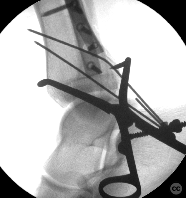 Mason III posterior malleolus fracture dislocation