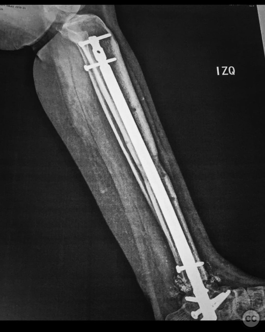 Staged Management Of Osteomyelitis Following Open Tibial Pilon Fracture