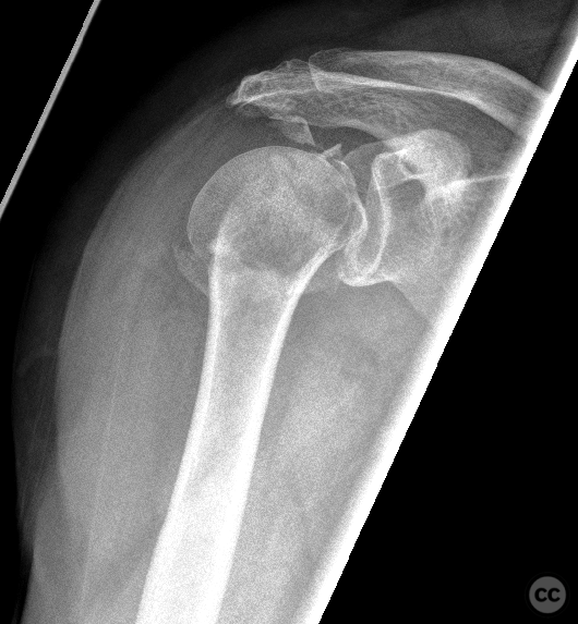 Reverse impacted Neer IV anatomical neck fracture