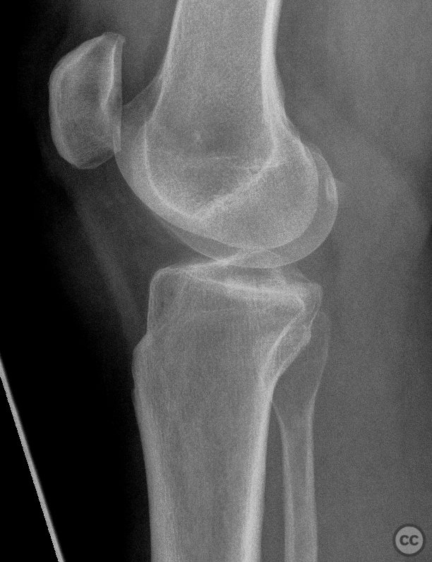 Shatzker 2 lateral tibial plateau fracture