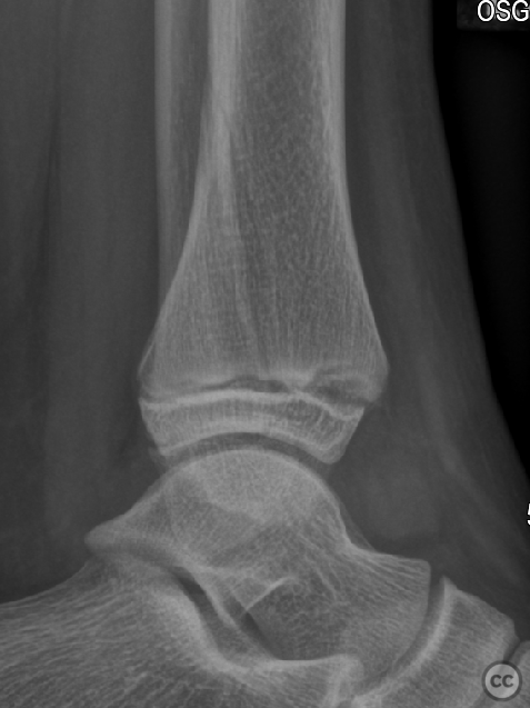 Percutaneous Cannulated Screw Fixation of a Triplanar Distal Tibial ...