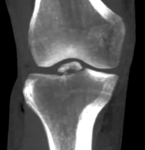 Tibial bony ACL avulsion - open screw osteosynthesis