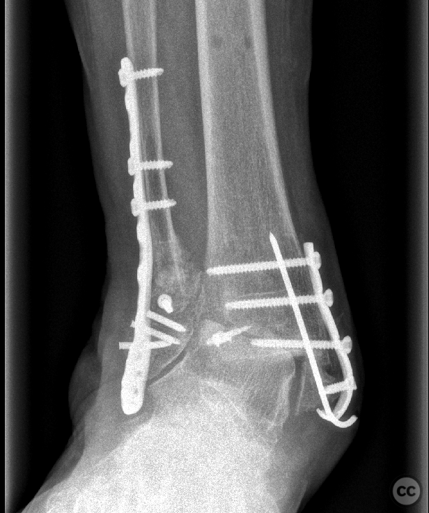 Failed pronation - external rotation (PER) ankle fracture dislocation