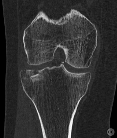 Shatzker 2 lateral tibial plateau fracture