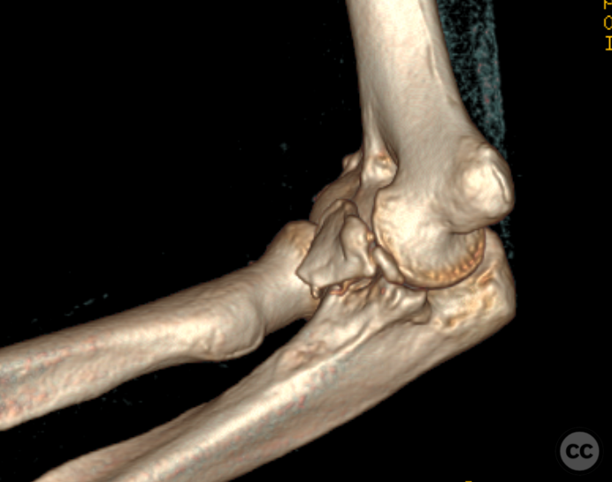 Odriscoll Type 3 Coronoid Fracture Dislocation