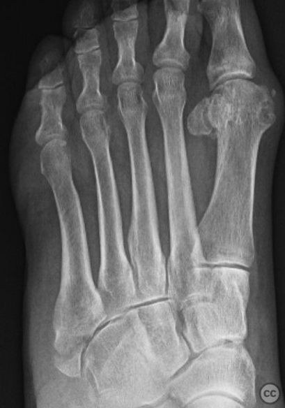 5th Metatarsal Zone 1 Fracture Repair with Dynamic Tension Band