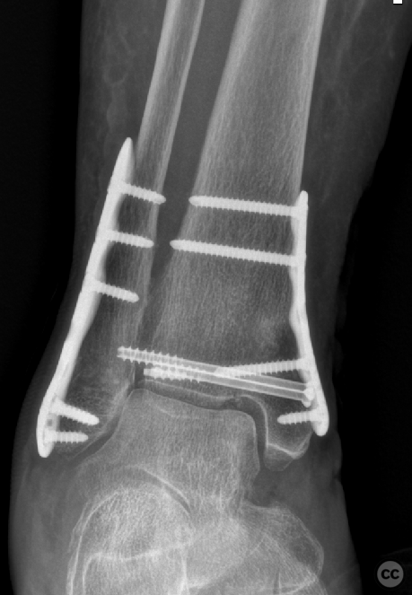 Bimalleolar Supination Adduction (SAd II) ankle injury