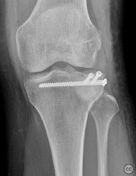 Jail-screw fixation posterolateral plateau impression fracture