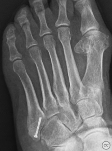 5th Metatarsal Zone 1 Fracture Repair with Dynamic Tension Band