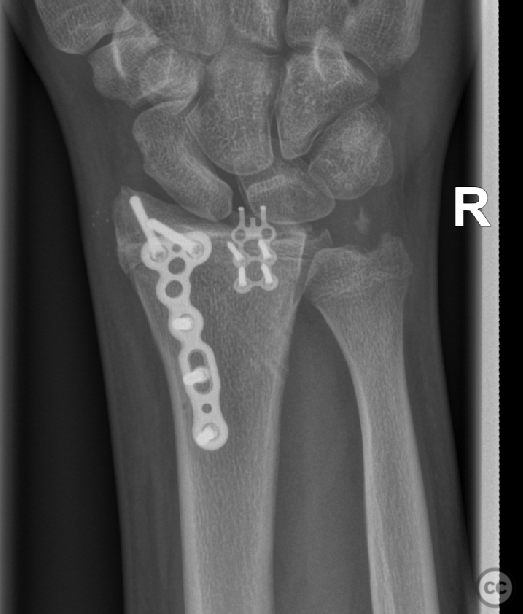 Malunion Salter III distal radius fracture dislocation