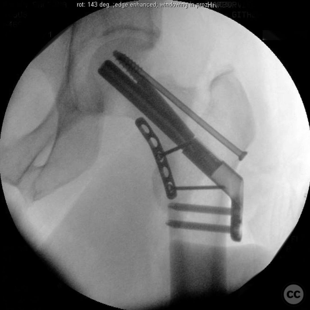 Vertical Displaced Femoral Neck Fracture 6743