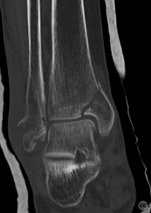 Ankle supination trauma