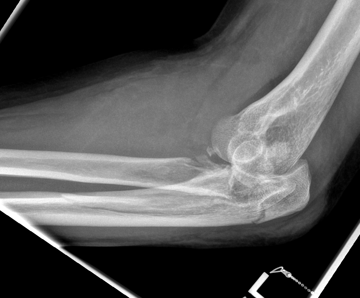 Complex Monteggia-like fracture dislocation with coronoid deficiency