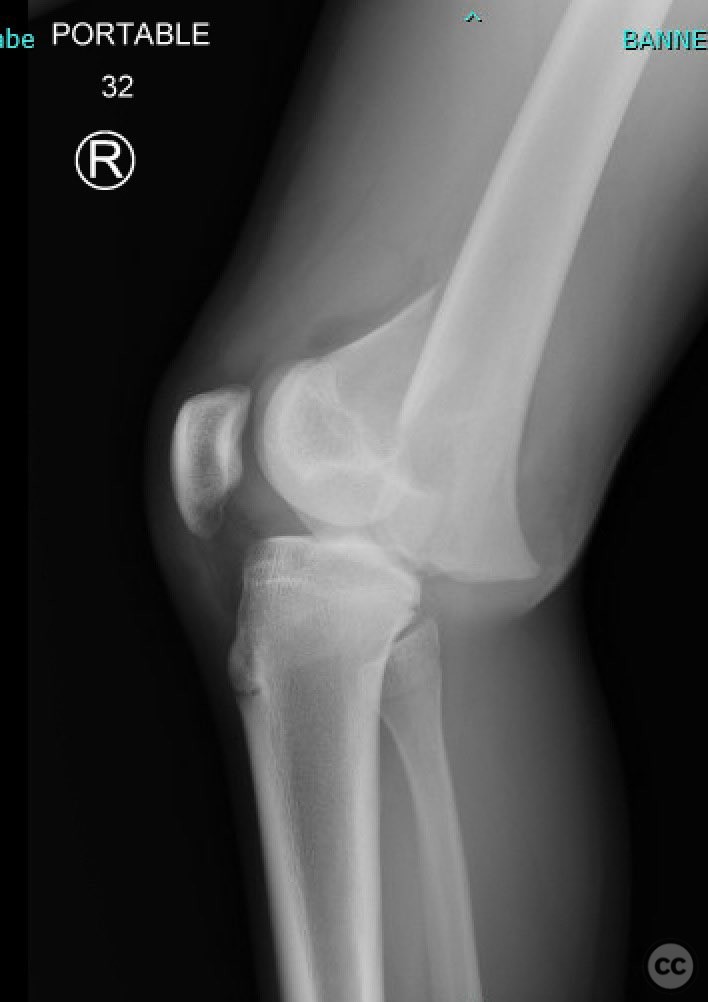 Salter Harris Ii Distal Femur Fracture 14yo M