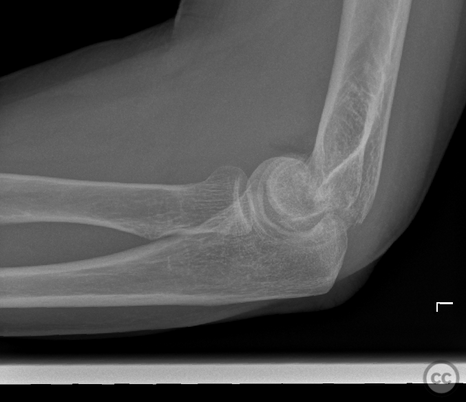 Dubberly 3/4 shear plus comminuted trans condylar trochlear fracture ...