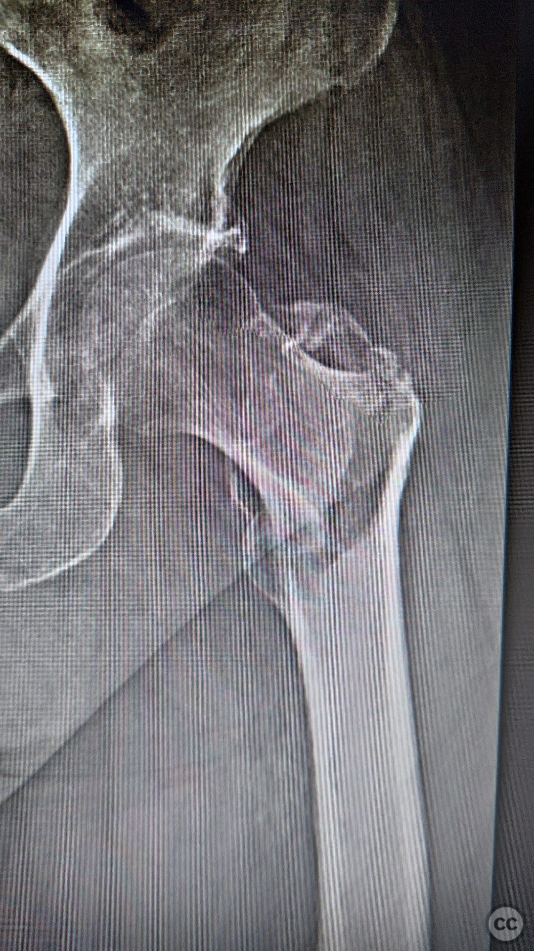 Basiservical femur fracture with trochanter major fracture