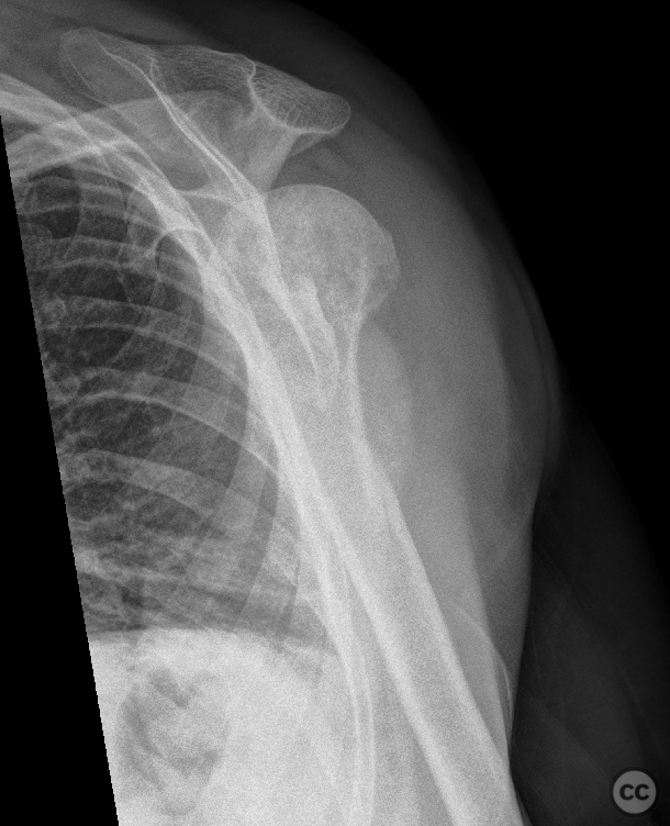 Prox 1/3 humeral shaft fracture with concomitant GH osteoarthritis