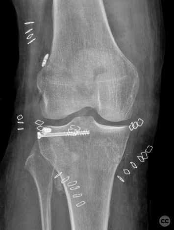 Posterolateral Tibial Plateau Fracture with ACL Reconstruction in a Ski ...