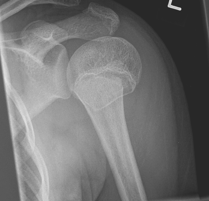 Salter Harris II proximal humerus fracture