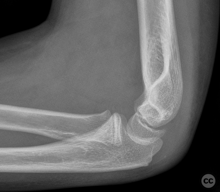 Pediatric Elbow Dislocation with Medial Epicondyle Fracture