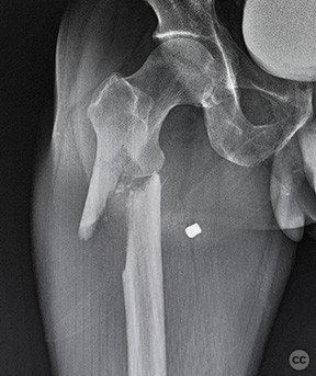 Subtrochanteric gunshot injury proximal femur