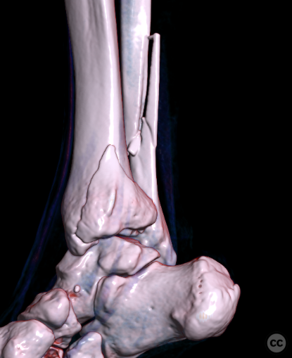 Mason III posterior malleolus fracture dislocation