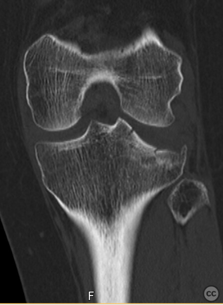 Jail-screw fixation posterolateral plateau impression fracture