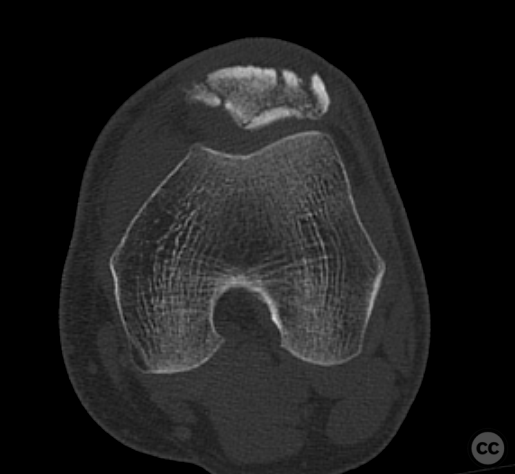 Comminuted patella fracture with inferior pole avulsion