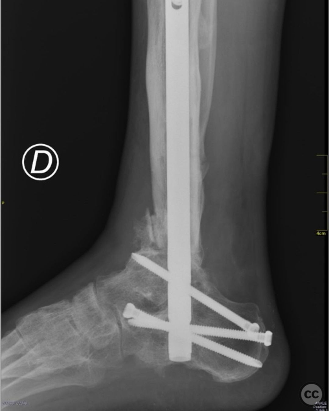 Analysis of bone transport for ankle arthrodesis as a limb salvage