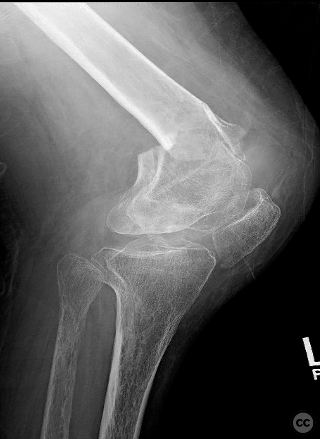 Supracondylar distal femur fracture in a patient with congenital dwarfism