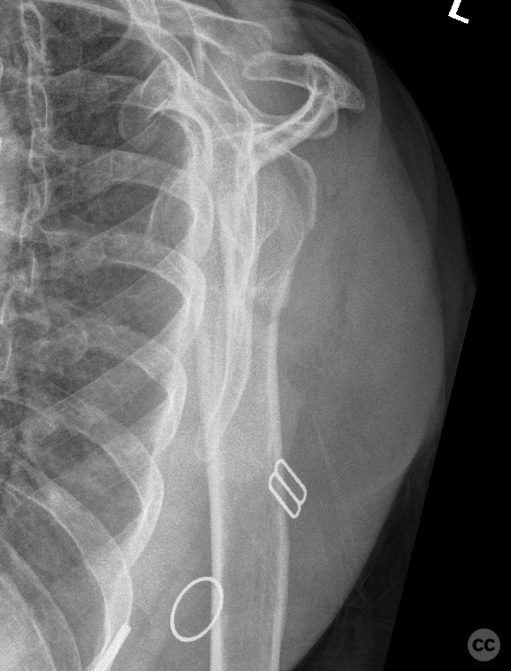 Impacted anatomical neck of humerus fracture with TM fragment