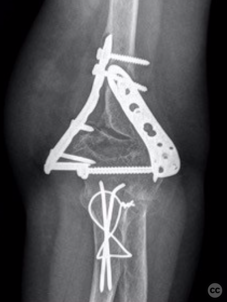 Post-operative Exercises, DePuy Synthes