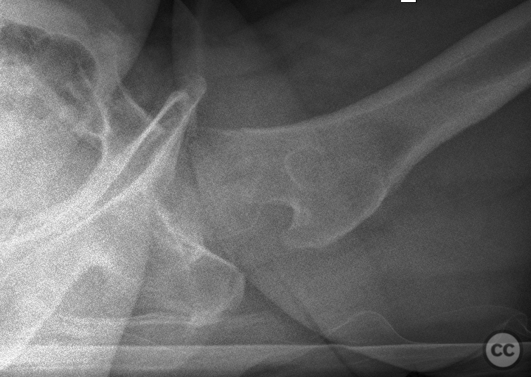 Garden I Subcapital Femoral Fracture in a 56yo Female