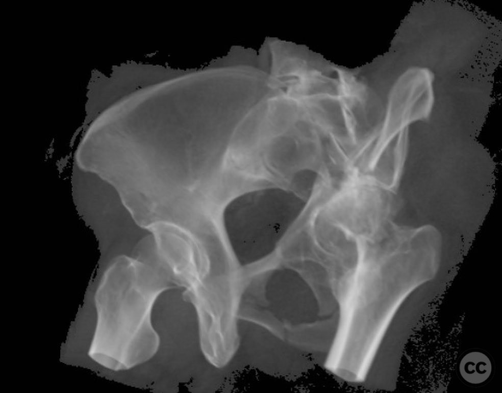 Associated Both Column Acetabular Fracture And A Femoral Neck Fracture With Oa