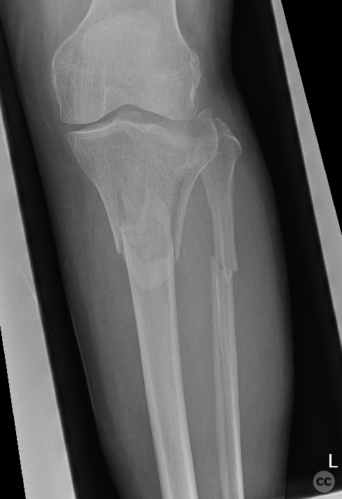 Combined tibial metaphysis and plateau fracture