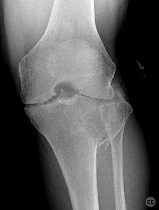 Posterolateral approach to the tibial plateau with femoral epicondylar ...