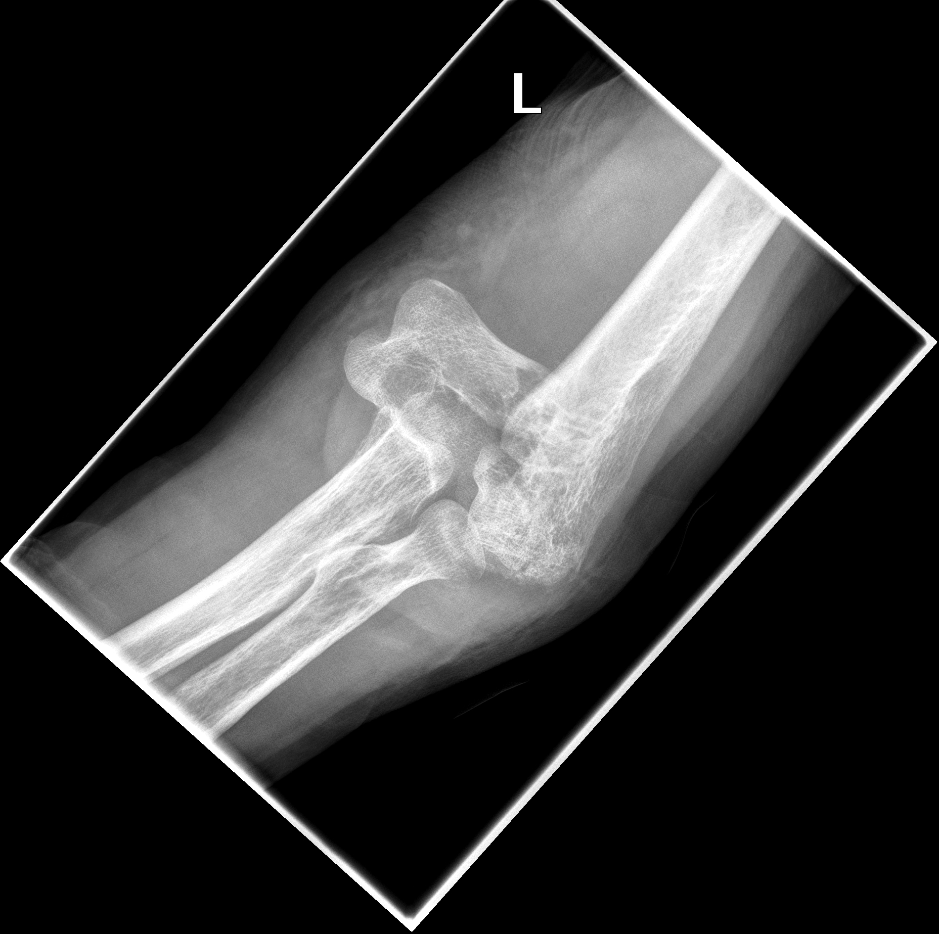 Comminuted C Articular Distal Humerus Fracture Without Osteotomy