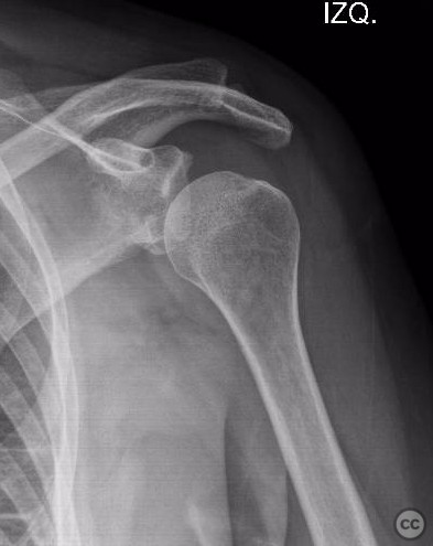 Anterior Shoulder Subluxation with Anterior Glena Fracture