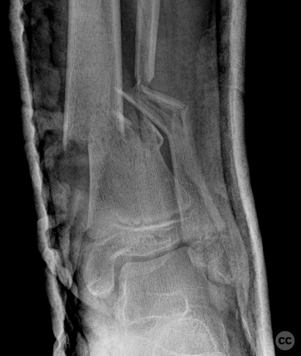 Pediatric tibia and fibula fracture following MVA