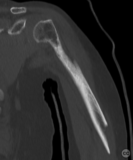 Aggregate lateral approach to a long segmental spiral humerus fracture