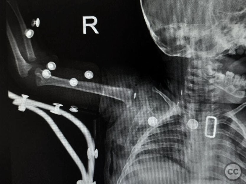 Latissimus Dorsi Transfer In Obstetrical Brachial Plexus Injury