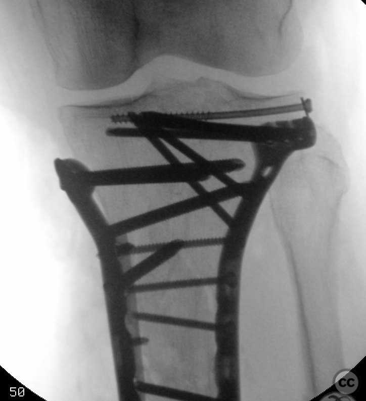 Combined tibial metaphysis and plateau fracture