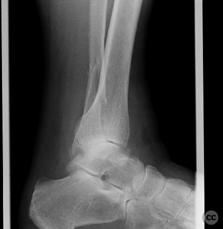 Chaput tubercle fracture in an adult bimalleolar ankle fracture