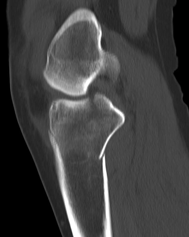 Schatzker VI tri-condylar fracture with pseudo PLC disruption